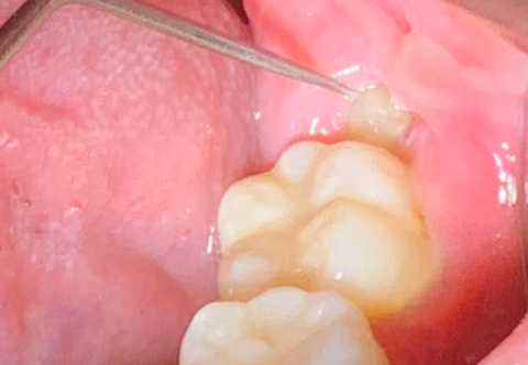 [GIẢI ĐÁP] Nhổ răng khôn bao lâu thì lành, bao lâu thì ăn được